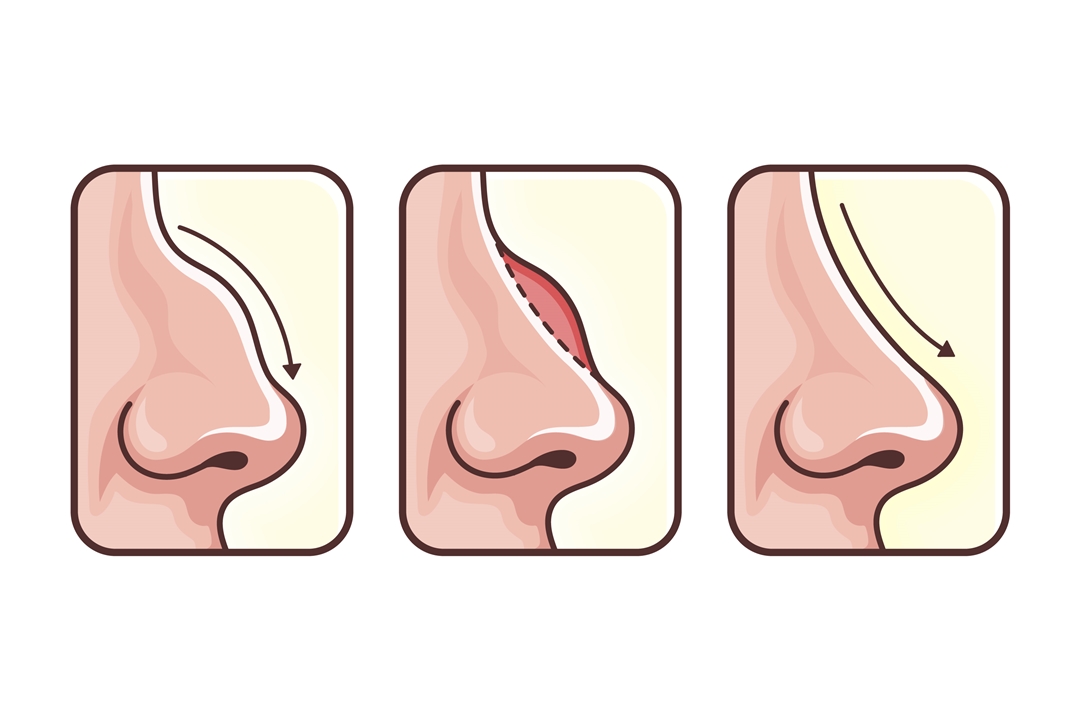 Rinomodelação X Rinoplastia Padma